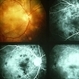 Choroiditis Choroiditis